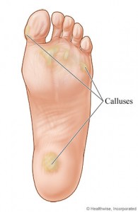 Foot-Calluses-Quakertown-PA.jpg